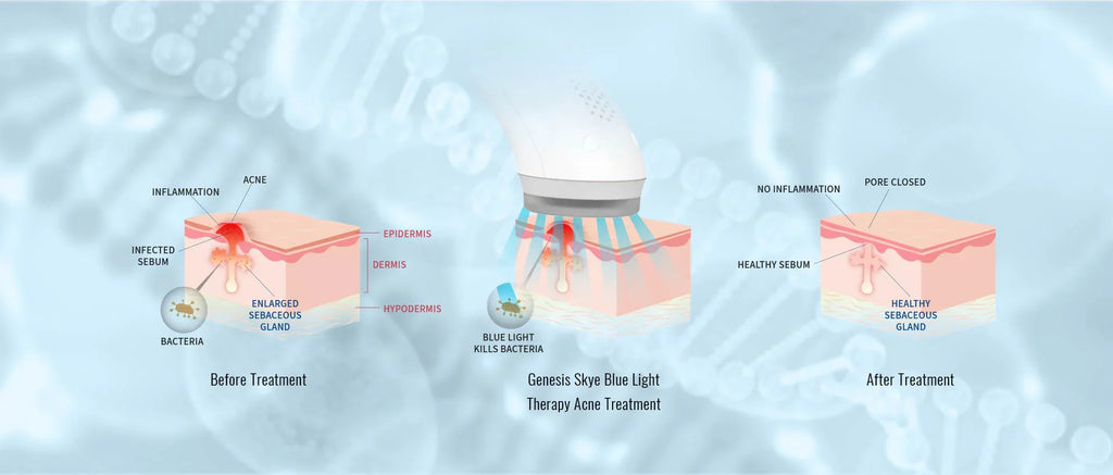 UV Blue Light Device